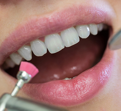 تنظيف الاسنان